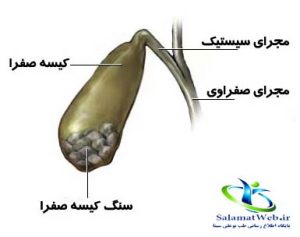بیماری سنگ کیسه صفرا