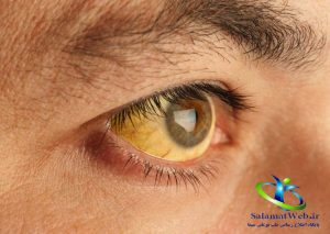 یرقان چیست؟