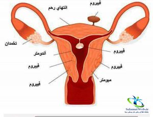 فیبروم رحمی