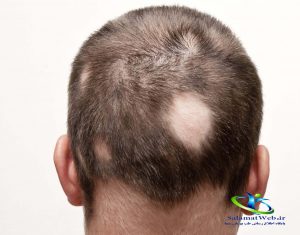 علل ریزش موی شدیددر طب ابوعلی سینا