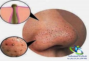 فیلم تخلیه جوش سر سیاه
