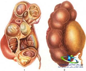 هیدرونفروز کلیه