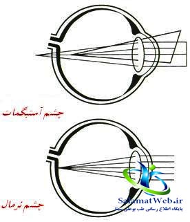 آستیگماتیسم چیست؟+تفاوت آستیگمات و ضعیفی چشم - سلامت وب طب بوعلی سینا