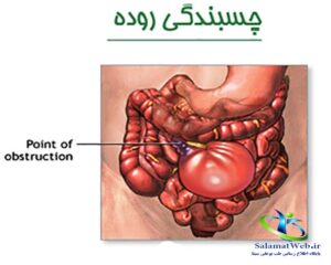بیماری چسبندگی روده