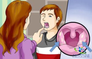 ورم لوزه چیست؟