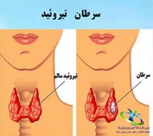 سرطان تیروئید چیست؟