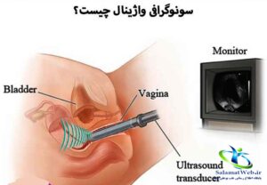 سونوگرافی واژینال چیست؟