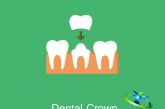 روکش دندان و انواع آن+ مزایا و معایب روکش دندان