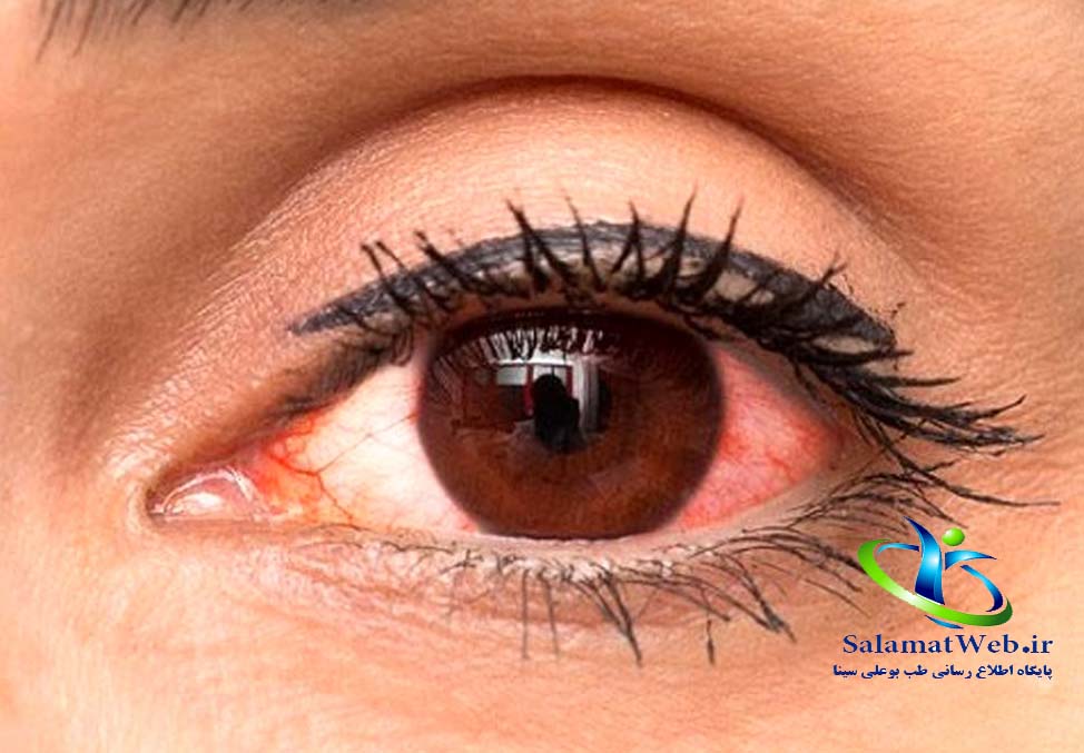 بیماری عفونت چشم