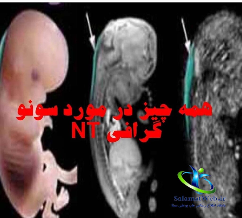 عدد نرمال سونوگرافی NT